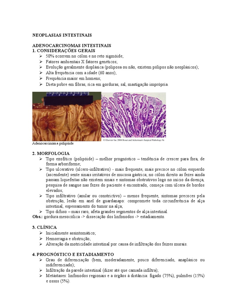 Neoplasias Intestinais Câncer Especialidades Médicas