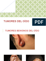 Tumores Del Oído