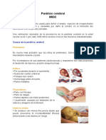 Parálisis Cerebral