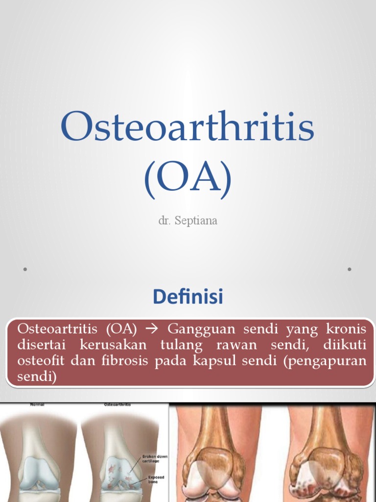 Panduan Lengkap Osteoartritis (OA) | PDF