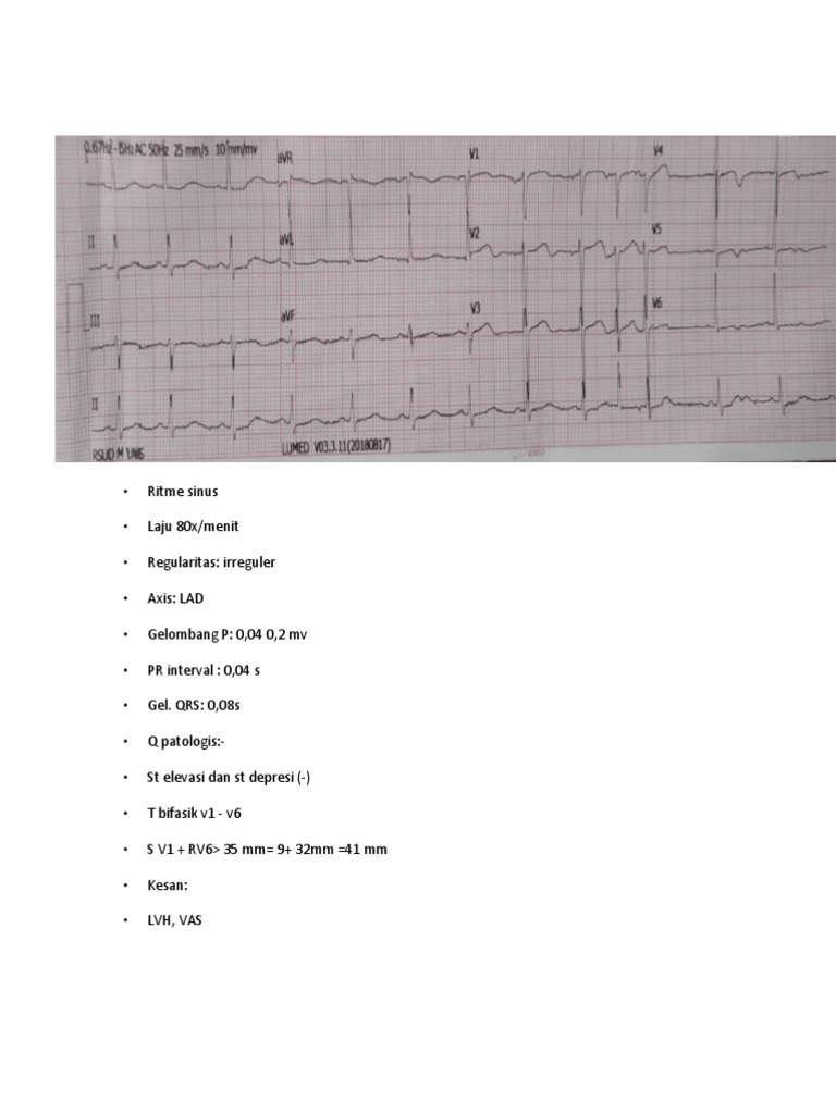 Interpretasi EKG: Sinus dan STEMI | PDF