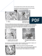 Transsphenoidal Resection