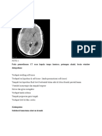 Pada Pemeriksaan CT Scan Kepala Tanpa Kontras, Potongan Aksial, Brain Window Didapatkan