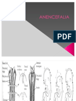 Anencefalia