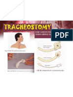 TRACHEOSTOMY