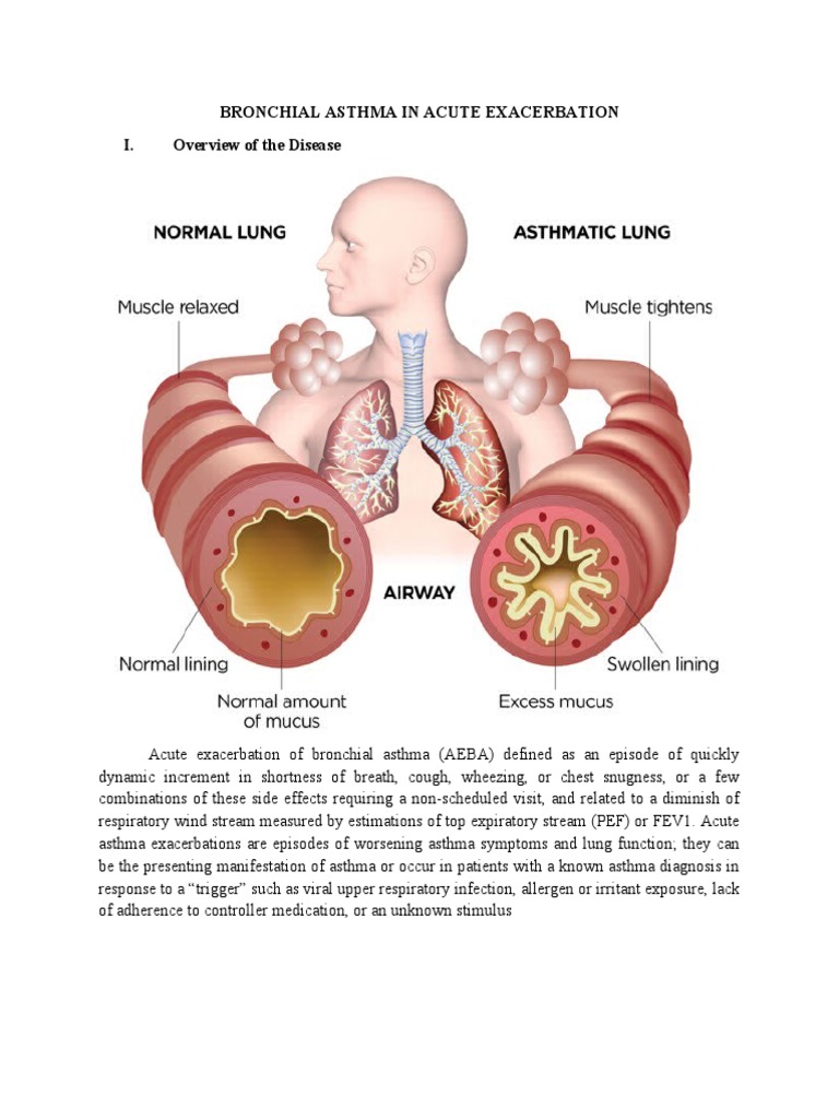 Bronchial Asthma in Acute Exacerbation Case Study PDF Lung Asthma