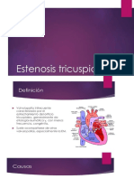 Estenosis Tricuspidea