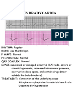 Sinus Bradycardia to Ventricular Fibrillation: Guide to Cardiac Arrhythmias