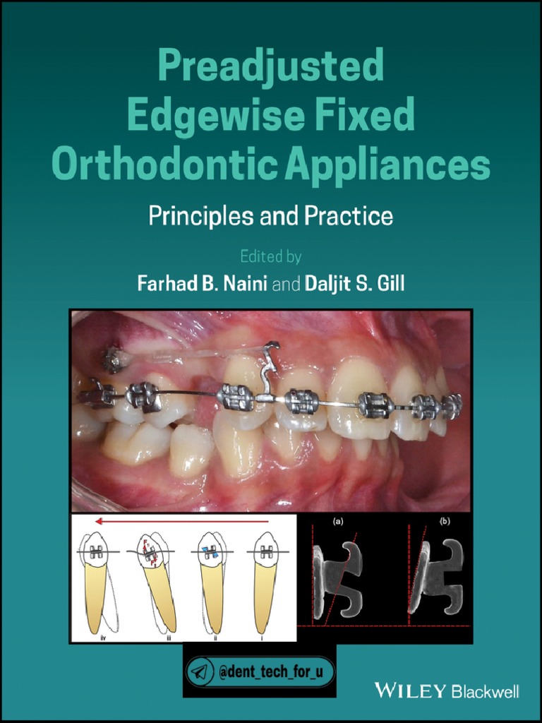 PDF) Effects of active and passive lacebacks on antero-posterior position  of maxillary first molars and central incisors