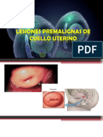 Lesiones Premalignas de Utero