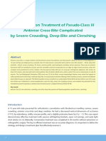 JDO 50 Non-Extraction Treatment of Pseudo Class III Anterior Cross Bite