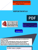 Hipertrofias Ekg3