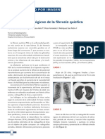 Hallazgos Radiológicos de La Fibrosis Quística: Iagnóstico Por Imagen