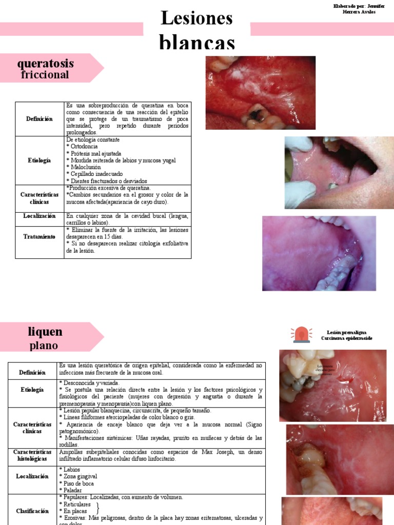 clasificaci-n-de-lesiones-blancas-bucales-pdf-epitelio-candidiasis