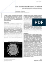 Lesiones Cerebrales Secundarias A Intoxicación Por Metanol: Brain Damage Due To Methanol Poisoning