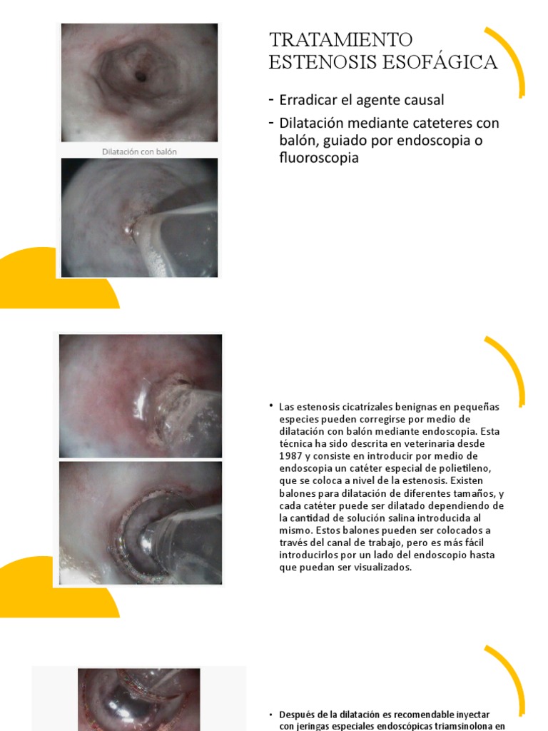 Tratamiento de Estenosis Esofágica | PDF | Endoscopia | Estómago
