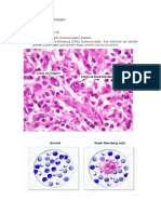 Histología Linfoma de Hodgkin