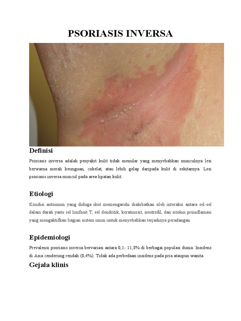 Psoriasis Inversa: Gejala dan Pengobatan | PDF