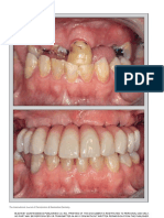 Martens2014 Peri Implant Outcome of Immediately Loaded Implant