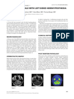 A 45-Year Old Male With Left-Sided Hemihypesthesia: Clinical History