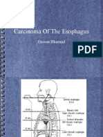 Carcinoma of The Esophagus: Hassan Bharmal