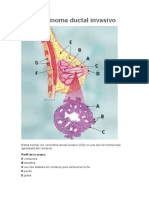 CDI: Guía del carcinoma ductal invasivo