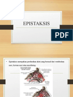 Epistaksis