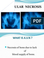 Avascular Necrosis of the Femoral Head: Causes, Symptoms and Treatment of Perthes Disease