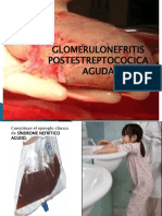 Glomerulonefritis 110507011723 Phpapp01