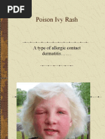 Poison Ivy Rash: A Type of Allergic Contact Dermatitis