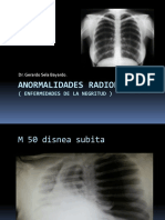 Anormalidades Radiolucidas: (Enfermedades de La Negritud)