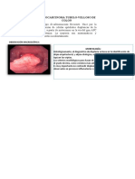 Adenocarcinoma Tubulo