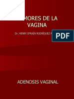 Tumores de La Vagina