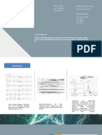 Caso Clínico de Un Tipo de Arritmia