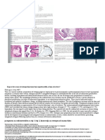 Endometroiden CA