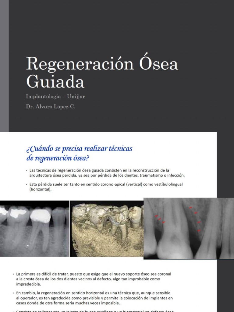 Regeneración Ósea Guiada | PDF | Salud y bienestar