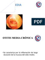 Otitis media crónica: causas, síntomas y tratamiento