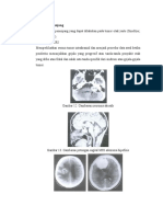 Pemeriksaan Penunjang Tumor Otak