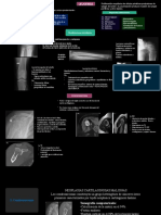 Leucemia y Condrosarcoma