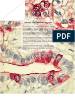 Tumors of The Exocrine Pancreas