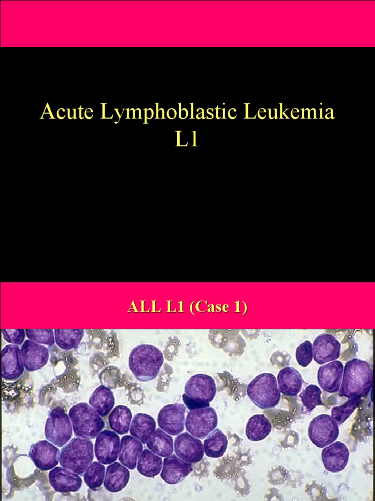 Acute Lymphoblastic Leukemia L1 Download Free Pdf Diseases And