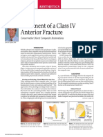 Treatment of A Class IV Anterior Fracture: Aesthetics