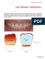 Cerâmica em Dentes Anteriores