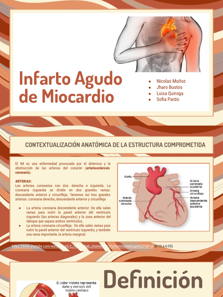Infarto Agudo de Miocardio | PDF | Infarto de miocardio | Corazón