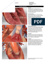 Ventricular Septal Defect (VSD) : Tetralogy of Fallot (TOF)