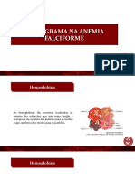 anemia+falciforme