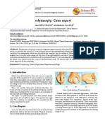 Bilateral Thumb Polydactyly: Case Report: Advances in Surgical Sciences
