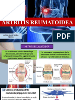Artritis Reumatoidea: Causas, Síntomas y Tratamiento