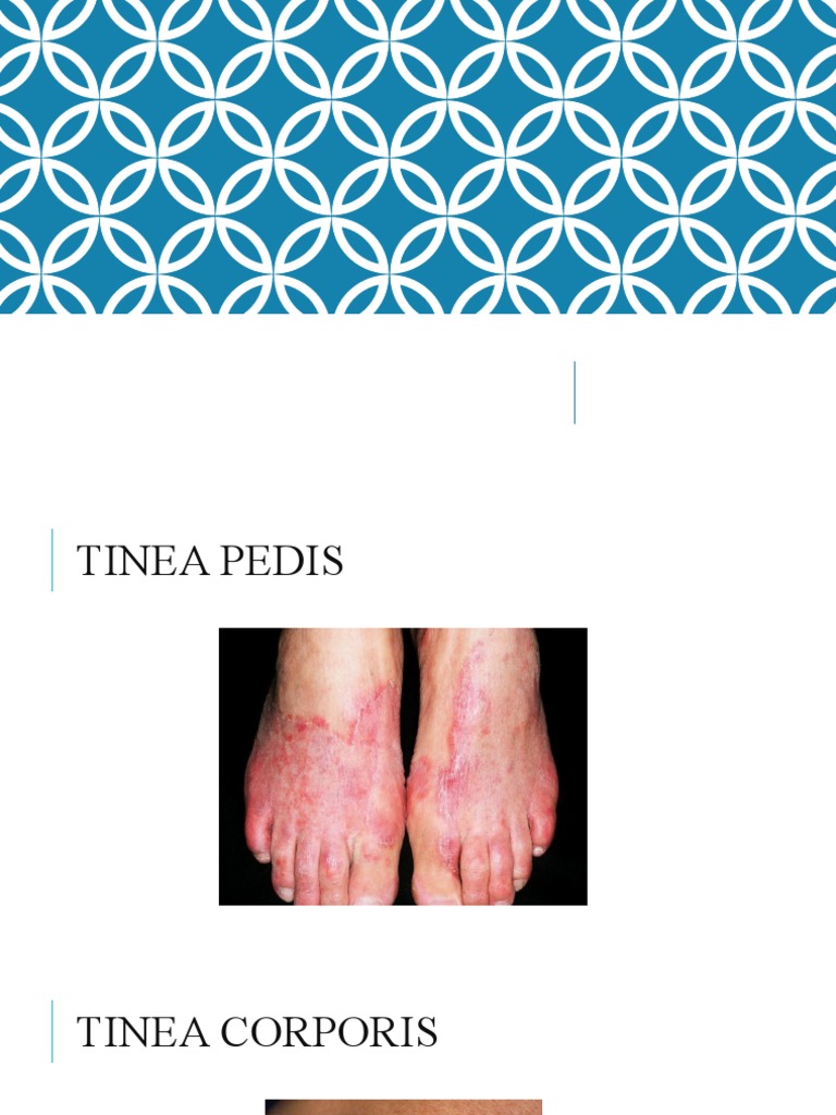 Diagnosis Banding Tinea Pedis | PDF