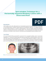 Simplified Open-Window Technique For A Horizontally Impacted Maxillary Canine With A Dilacerated Root